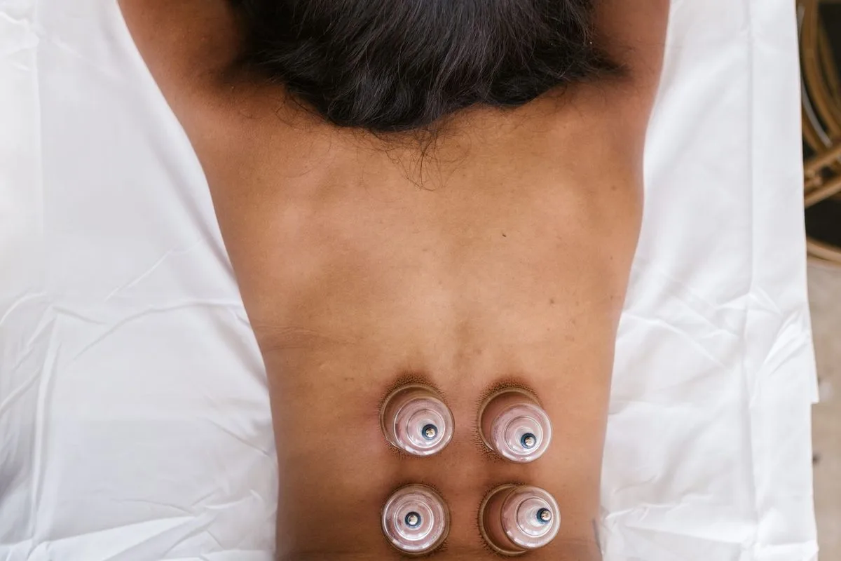 Cupping therapy cups placed on a patient's back